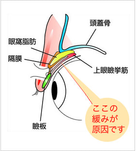 老化が原因の眼瞼下垂