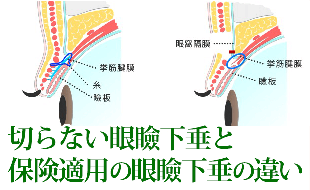 切らない眼瞼下垂と保険適用の眼瞼下垂の違い