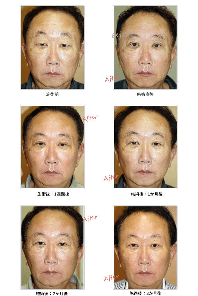 保険適用の眼瞼下垂手術（挙筋前転法）