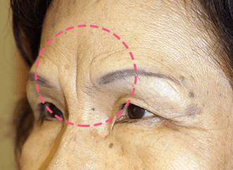スーパーコラーゲン注射 眉間のシワ おでこのシワ ほうれい線治療 眼瞼下垂症例3000件以上 保険診療から眼瞼下垂の修正術まで 大阪の立花クリニック